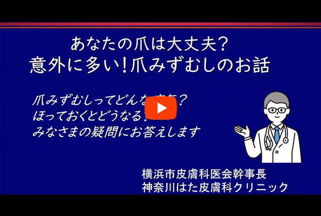 あなたの爪は大丈夫？意外に多い！爪みずむしのお話